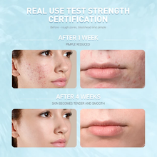 Load image into Gallery viewer, Salicylic Acid Acne Treatment- Skincare
